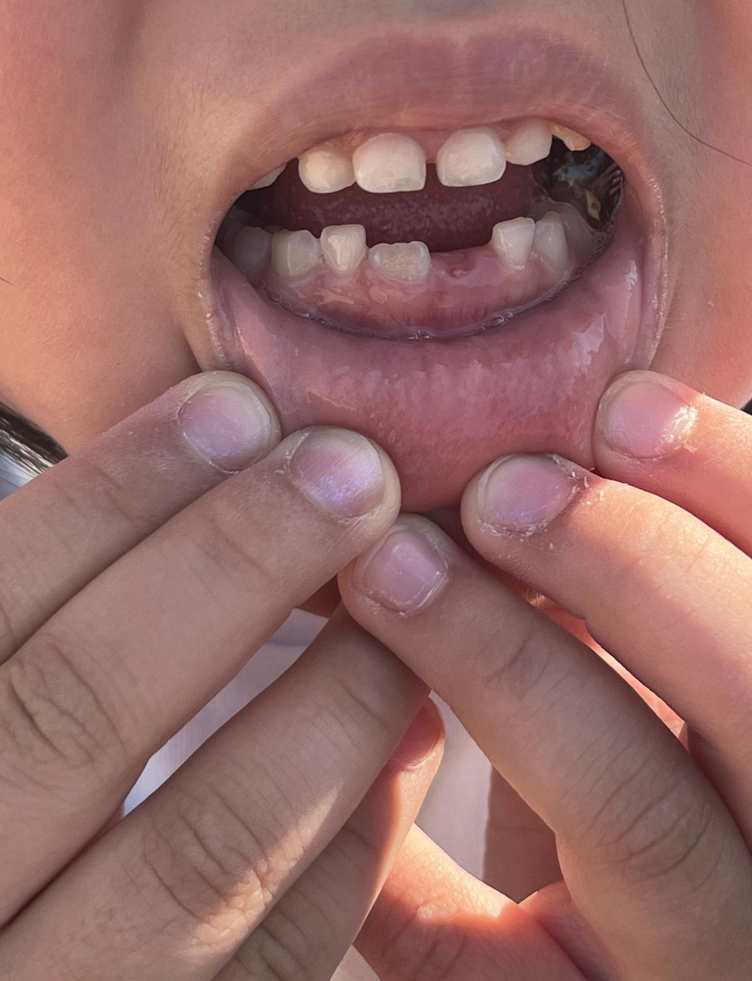 歯が抜けたよう